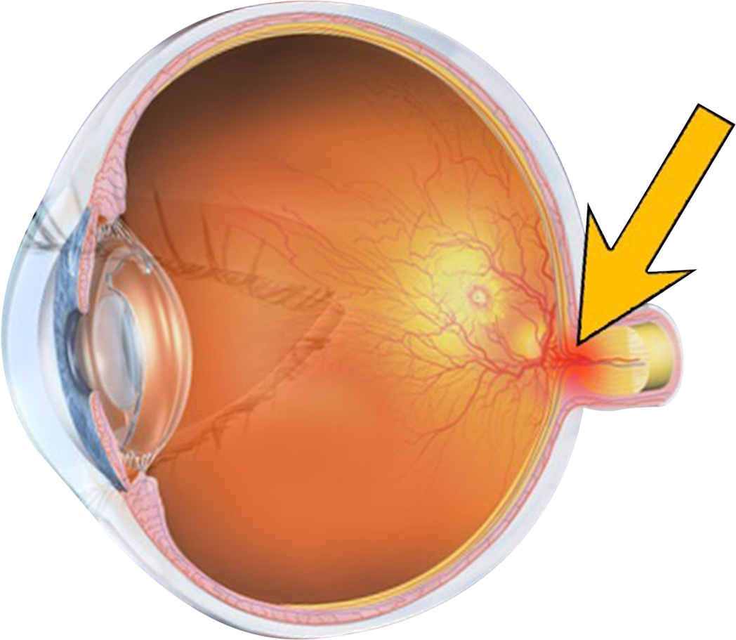 Glaucoma