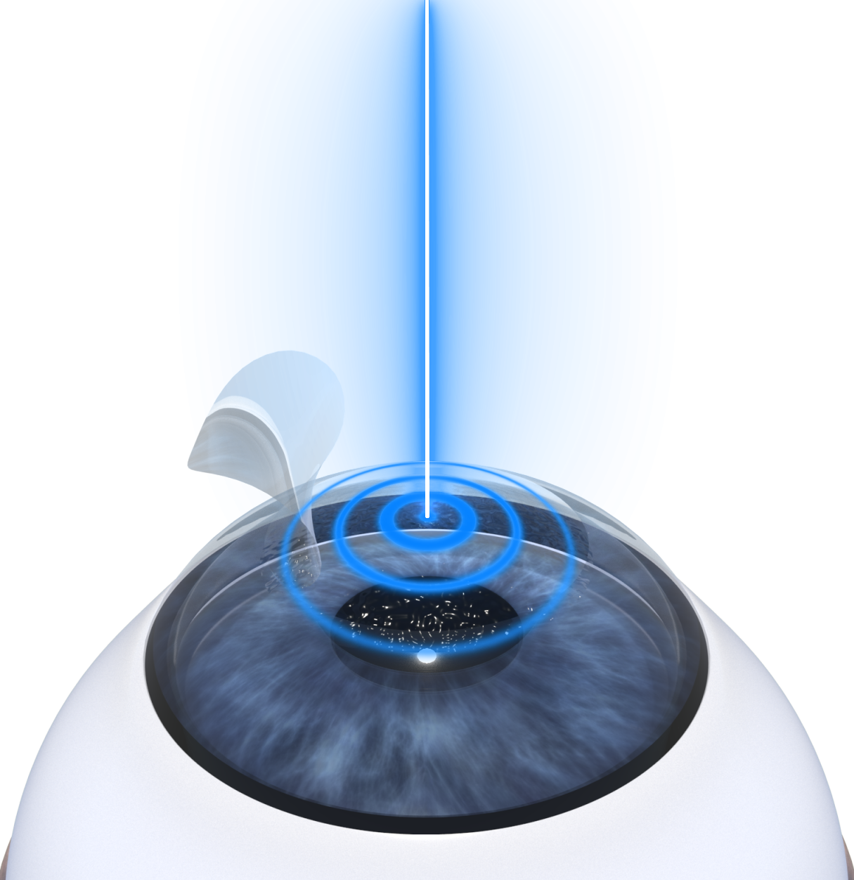 LASIK Surgery