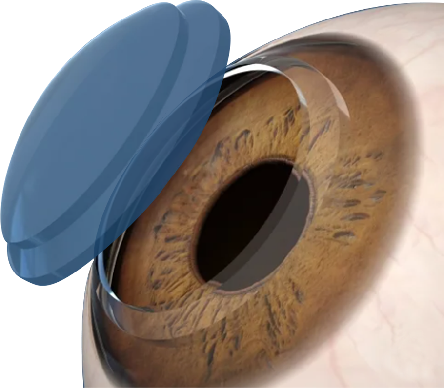 Cornea