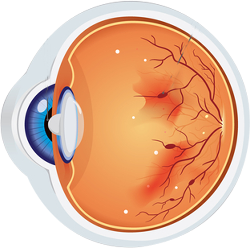 Diabetic Retinopathy